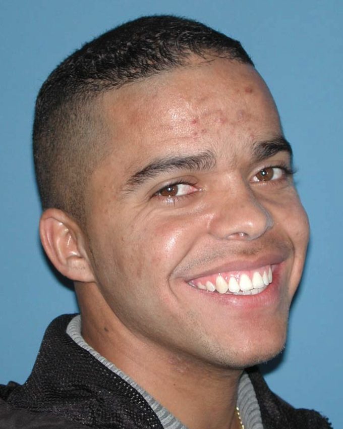 Paciente Fernando sorrindo após o tratamento